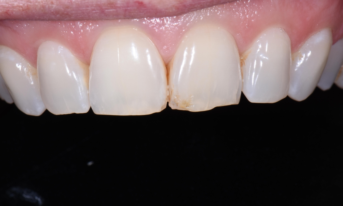 Composite or “Tooth Colored” Fillings - Albany