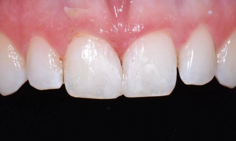 Diastema-Closure-After-Image