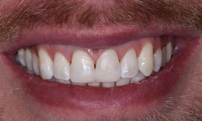 Invisalign-and-Kor-Whitening-After-Image