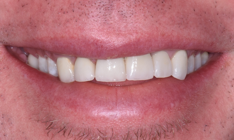 Invisalign-and-Porcelain-Crowns-to-correct-Uneven-Gum-Line-After-Image