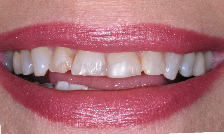 Cosmetic-Dentistry-Before-Image
