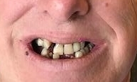 Full-Mouth-Implants-Before-Image