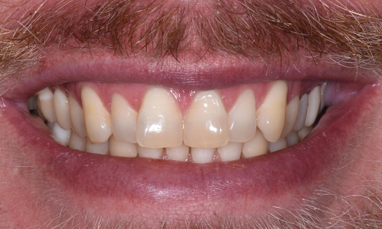 Invisalign-and-Kor-Whitening-Before-Image