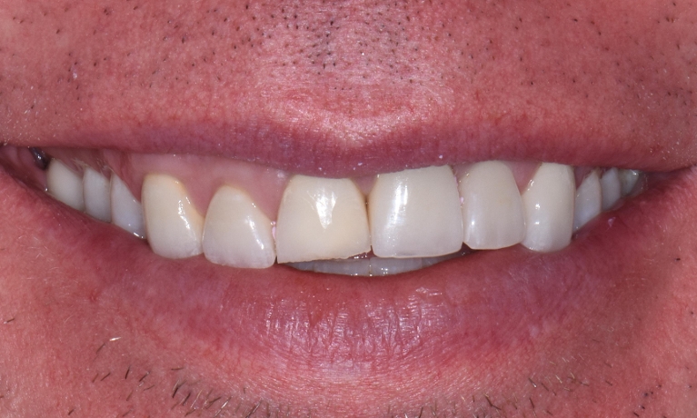 Invisalign-and-Porcelain-Crowns-to-correct-Uneven-Gum-Line-Before-Image